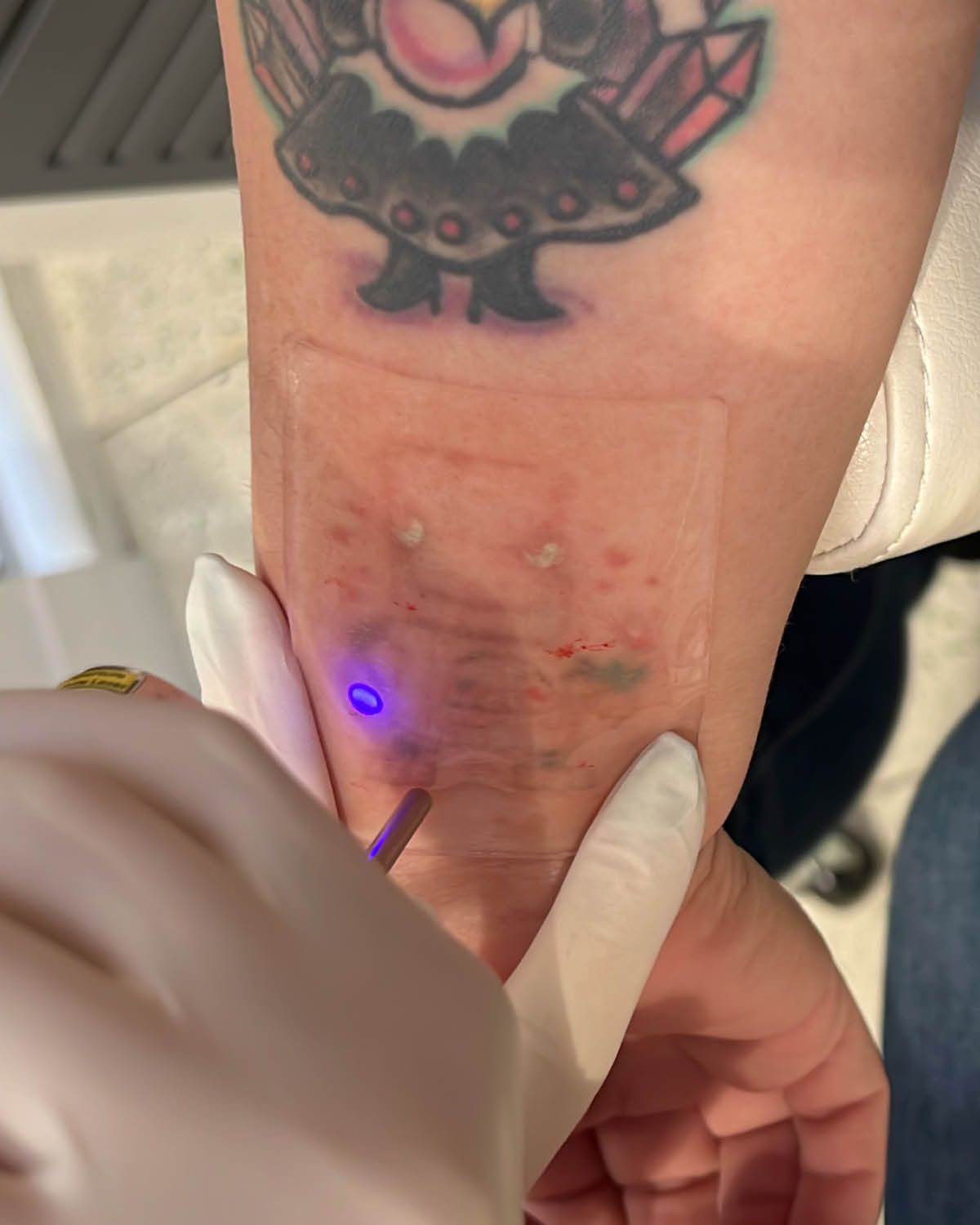 tattoo removal